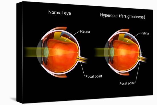 Comparison of a normal eye and an eye with hyperopia.-Stocktrek Images-Stretched Canvas