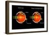 Comparison of a normal eye and an eye with myopia.-Stocktrek Images-Framed Art Print