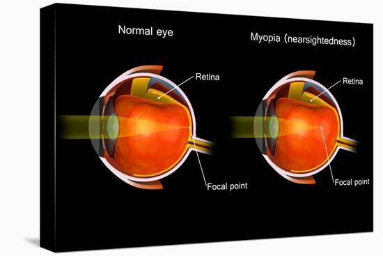 Comparison of a normal eye and an eye with myopia.-Stocktrek Images-Stretched Canvas