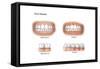 Comparison of Healthy Gums Versus Gingivitis-null-Framed Stretched Canvas