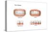 Comparison of Healthy Gums Versus Gingivitis-null-Stretched Canvas