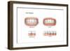 Comparison of Healthy Gums Versus Gingivitis-null-Framed Art Print