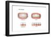 Comparison of Healthy Gums Versus Gingivitis-null-Framed Art Print