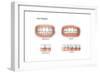 Comparison of Healthy Gums Versus Gingivitis-null-Framed Art Print