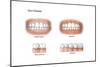 Comparison of Healthy Gums Versus Gingivitis-null-Mounted Art Print