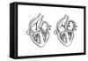 Comparison of Normal Heart Versus Heart with a Patent Foramen Ovale-null-Framed Stretched Canvas