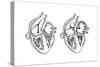 Comparison of Normal Heart Versus Heart with a Patent Foramen Ovale-null-Stretched Canvas