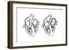 Comparison of Normal Heart Versus Heart with a Patent Foramen Ovale-null-Framed Art Print