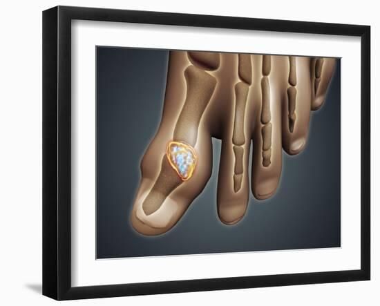 Conceptual Image of Gout in the Big Toe-null-Framed Art Print