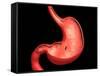 Conceptual Image of Peptic Ulcer in Human Stomach-null-Framed Stretched Canvas