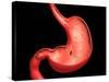 Conceptual Image of Peptic Ulcer in Human Stomach-null-Stretched Canvas