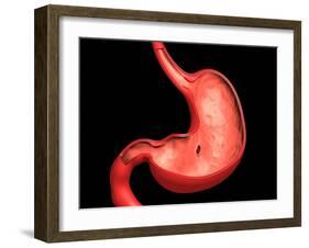 Conceptual Image of Peptic Ulcer in Human Stomach-null-Framed Art Print