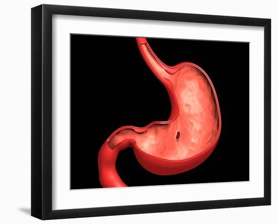 Conceptual Image of Peptic Ulcer in Human Stomach-null-Framed Art Print