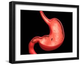 Conceptual Image of Peptic Ulcer in Human Stomach-null-Framed Art Print