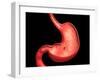 Conceptual Image of Peptic Ulcer in Human Stomach-null-Framed Art Print