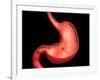 Conceptual Image of Peptic Ulcer in Human Stomach-null-Framed Art Print