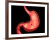 Conceptual Image of Peptic Ulcer in Human Stomach-null-Framed Art Print
