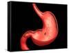 Conceptual Image of Peptic Ulcer in Human Stomach-null-Framed Stretched Canvas