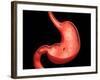 Conceptual Image of Peptic Ulcer in Human Stomach-null-Framed Art Print