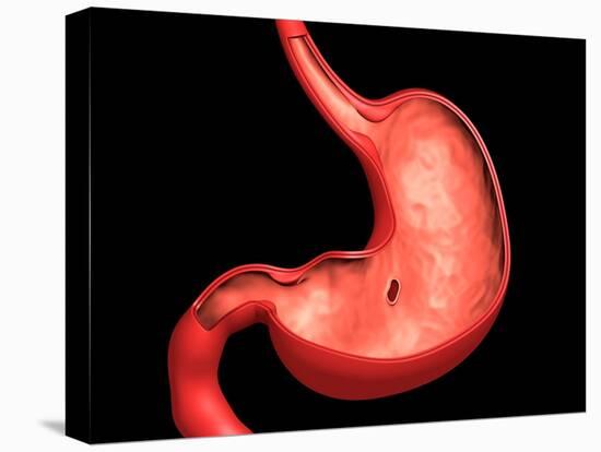 Conceptual Image of Peptic Ulcer in Human Stomach-null-Stretched Canvas