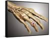 Conceptual Image of Rheumatoid Arthritis in the Human Hand-null-Framed Stretched Canvas