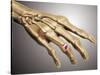 Conceptual Image of Rheumatoid Arthritis in the Human Hand-null-Stretched Canvas