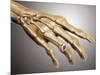 Conceptual Image of Rheumatoid Arthritis in the Human Hand-null-Mounted Art Print