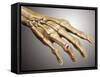 Conceptual Image of Rheumatoid Arthritis in the Human Hand-null-Framed Stretched Canvas