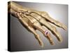Conceptual Image of Rheumatoid Arthritis in the Human Hand-null-Stretched Canvas