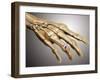 Conceptual Image of Rheumatoid Arthritis in the Human Hand-null-Framed Art Print