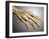 Conceptual Image of Rheumatoid Arthritis in the Human Hand-null-Framed Art Print