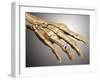 Conceptual Image of Rheumatoid Arthritis in the Human Hand-null-Framed Art Print