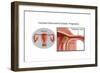 Cornual/Interstitial Pregnancy-Gwen Shockey-Framed Art Print