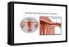 Cornual/Interstitial Pregnancy-Gwen Shockey-Framed Stretched Canvas