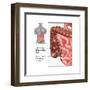 Crohn's Disease, IBD, Illustration-Gwen Shockey-Framed Art Print