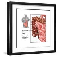 Crohn's Disease, IBD, Illustration-Gwen Shockey-Framed Art Print