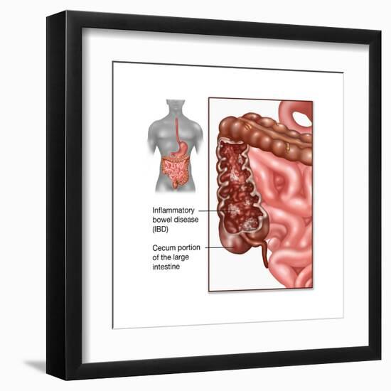 Crohn's Disease, IBD, Illustration-Gwen Shockey-Framed Art Print