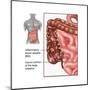 Crohn's Disease, IBD, Illustration-Gwen Shockey-Mounted Art Print