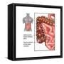 Crohn's Disease, IBD, Illustration-Gwen Shockey-Framed Stretched Canvas