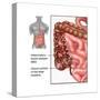 Crohn's Disease, IBD, Illustration-Gwen Shockey-Stretched Canvas