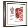 Crohn's Disease, IBD, Illustration-Gwen Shockey-Framed Art Print