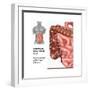 Crohn's Disease, IBD, Illustration-Gwen Shockey-Framed Art Print