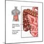 Crohn's Disease, IBD, Illustration-Gwen Shockey-Mounted Art Print