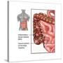 Crohn's Disease, IBD, Illustration-Gwen Shockey-Stretched Canvas