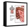 Crohn's Disease, IBD, Illustration-Gwen Shockey-Framed Stretched Canvas