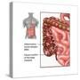 Crohn's Disease, IBD, Illustration-Gwen Shockey-Stretched Canvas