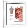 Crohn's Disease, IBD, Illustration-Gwen Shockey-Framed Art Print
