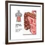 Crohn's Disease, IBD, Illustration-Gwen Shockey-Framed Art Print