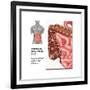 Crohn's Disease, IBD, Illustration-Gwen Shockey-Framed Art Print