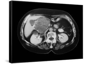 Cystic Pancreas Tumour, CT Scan-ZEPHYR-Framed Stretched Canvas